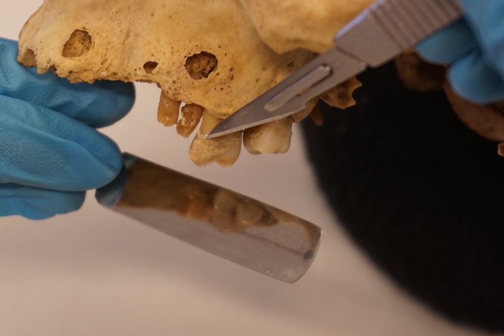 Taking a sample of dental calculus from an individuals buried in San Ignacio